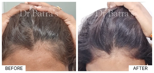 Hair Falling Treatment